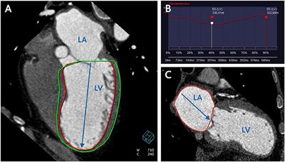 Surgical Restoration of Antero-Apical Left Ventricular Aneurysms: Cardiac Computed Tomography for Therapy Planning